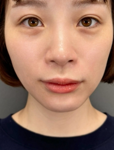 after画像