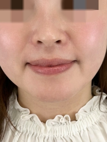 before画像