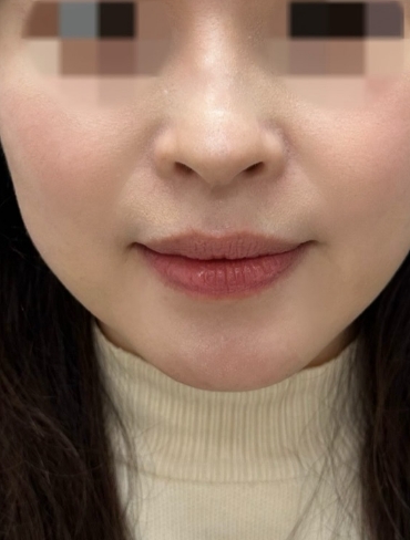 after画像