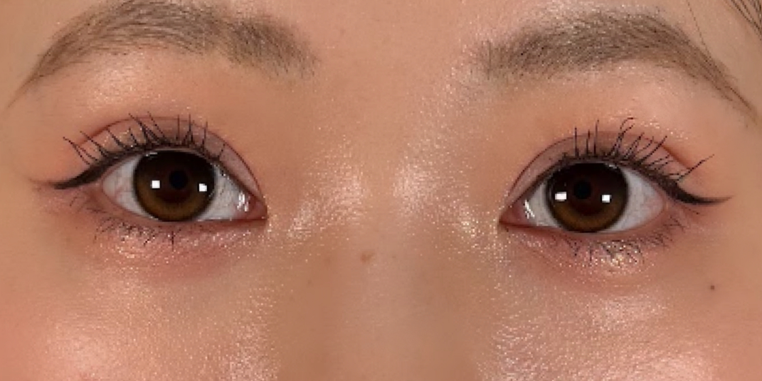 症例のafter画像