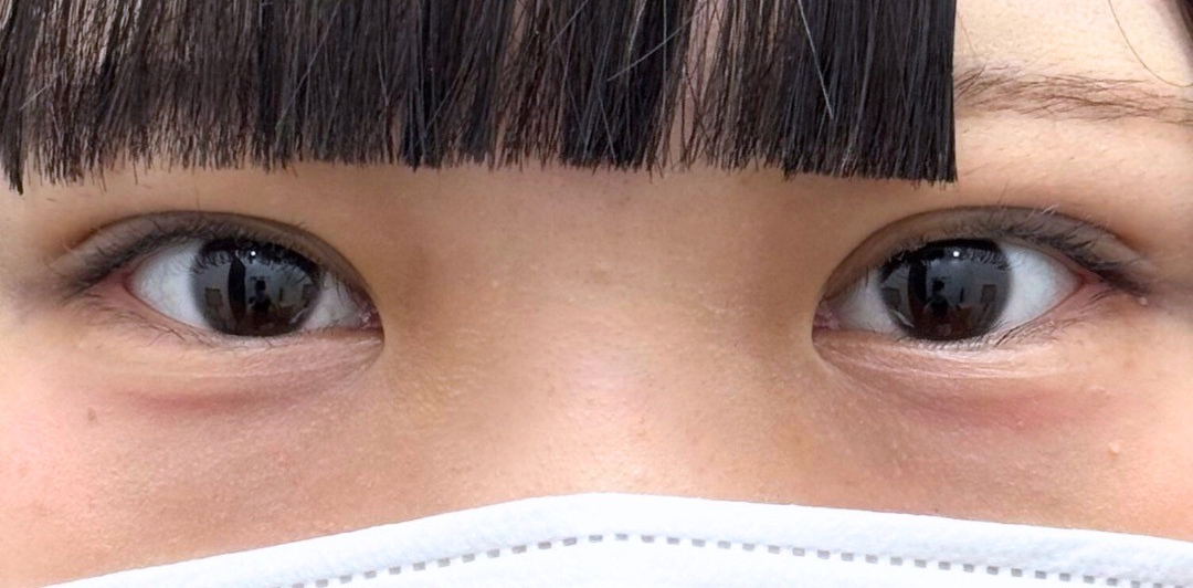 症例のafter画像