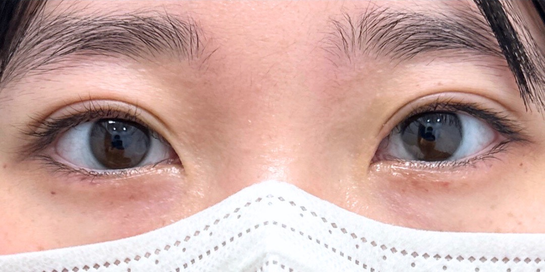 症例のafter画像