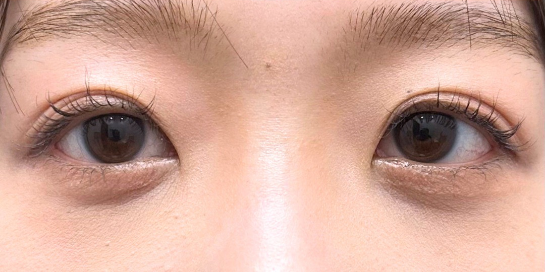 症例のafter画像