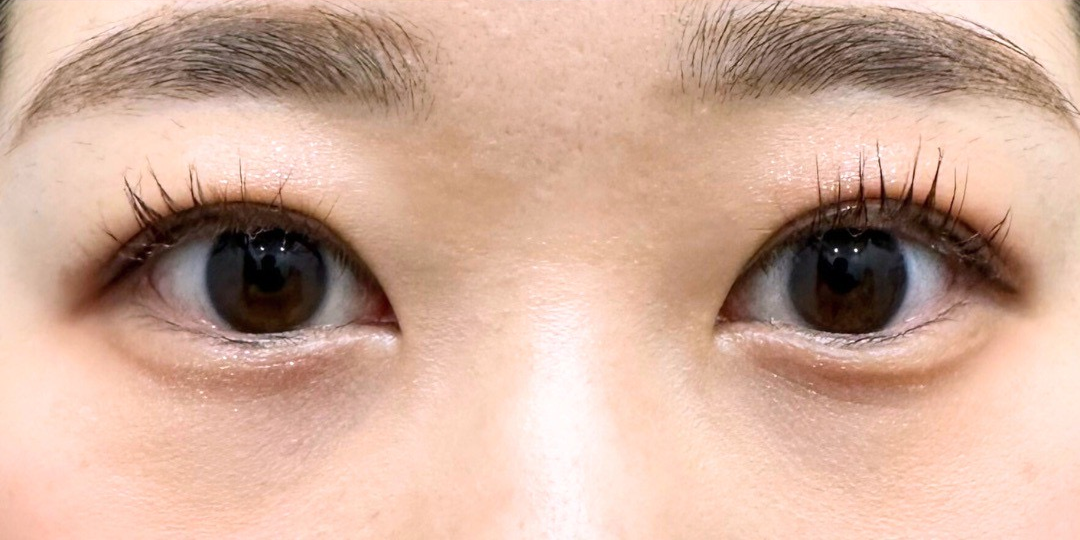 症例のafter画像