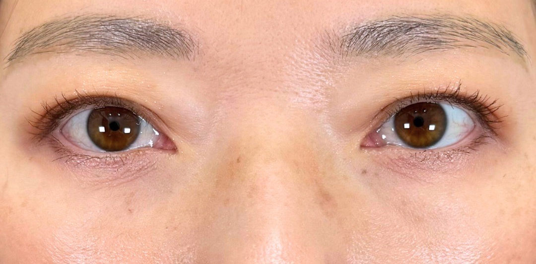 症例のafter画像