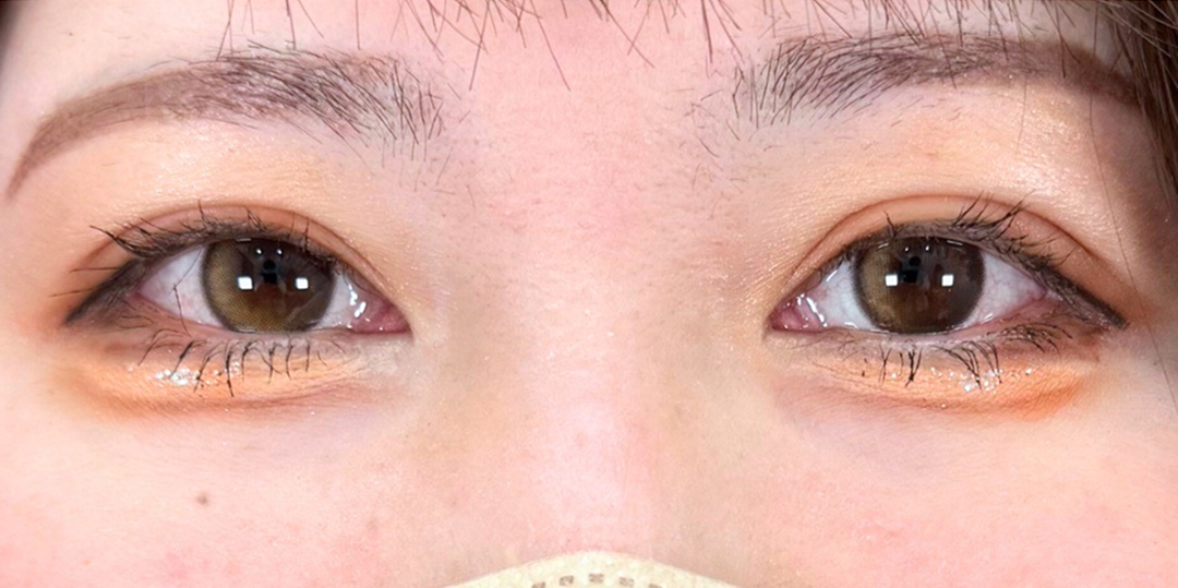 症例のafter画像