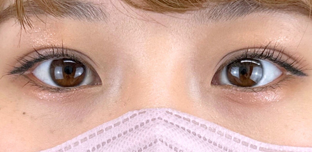 症例のafter画像