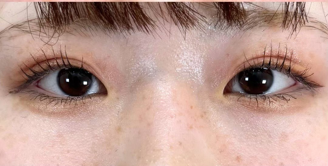 症例のafter画像