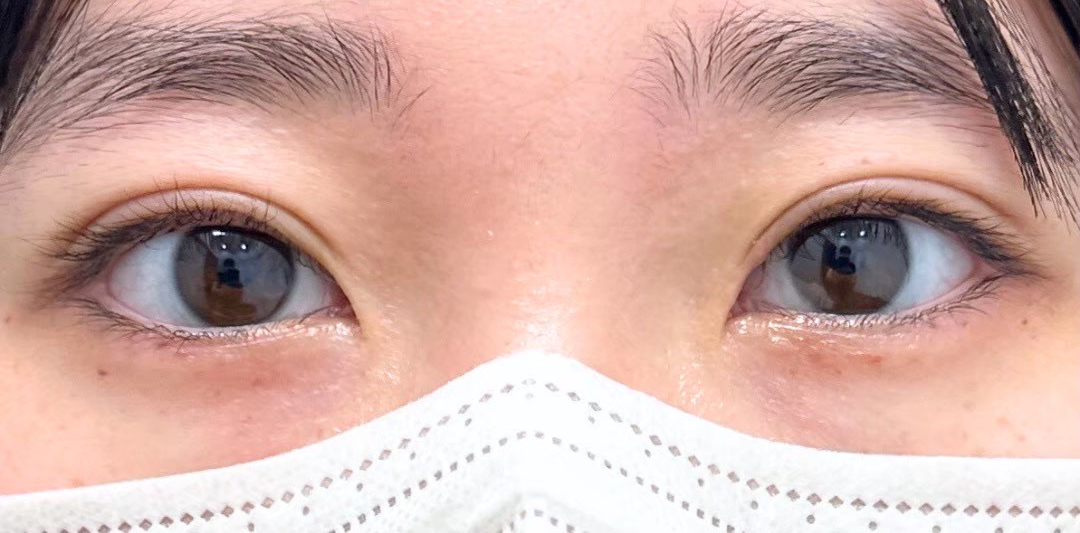 症例のafter画像