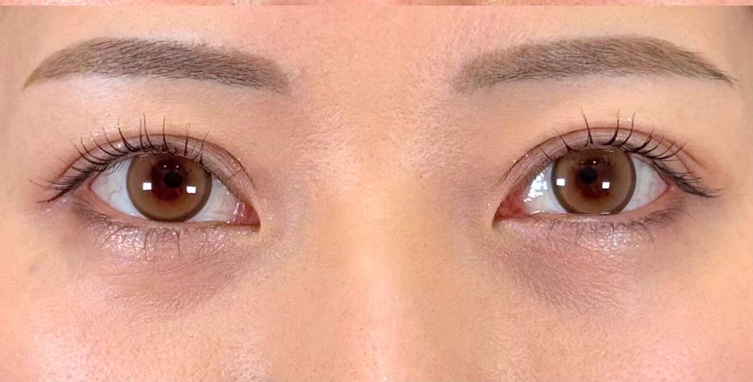 症例のafter画像