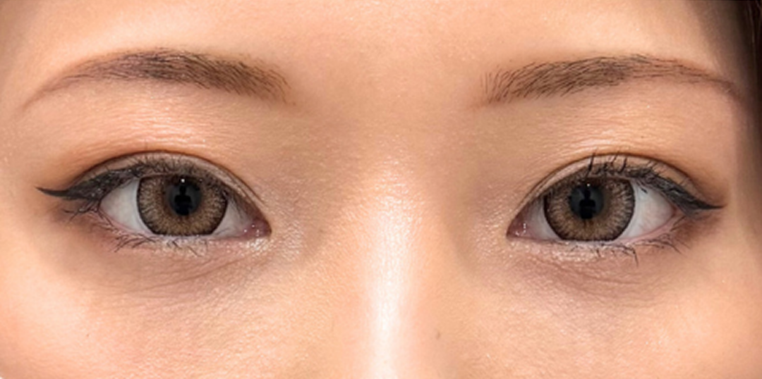 症例のafter画像