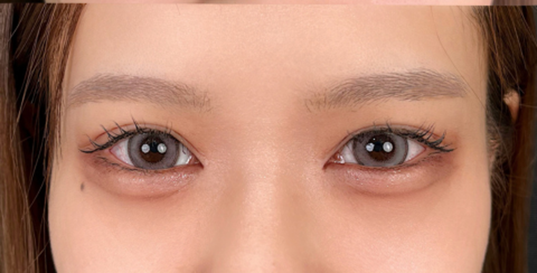 症例のafter画像