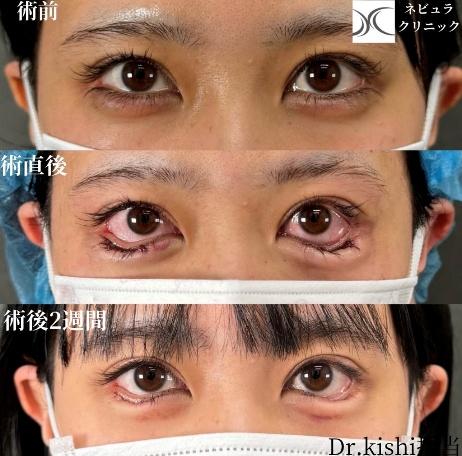 切らないタレ目形成 症例写真