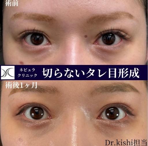 切開法比較写真