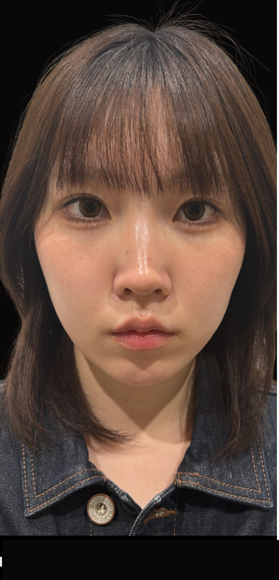 after画像