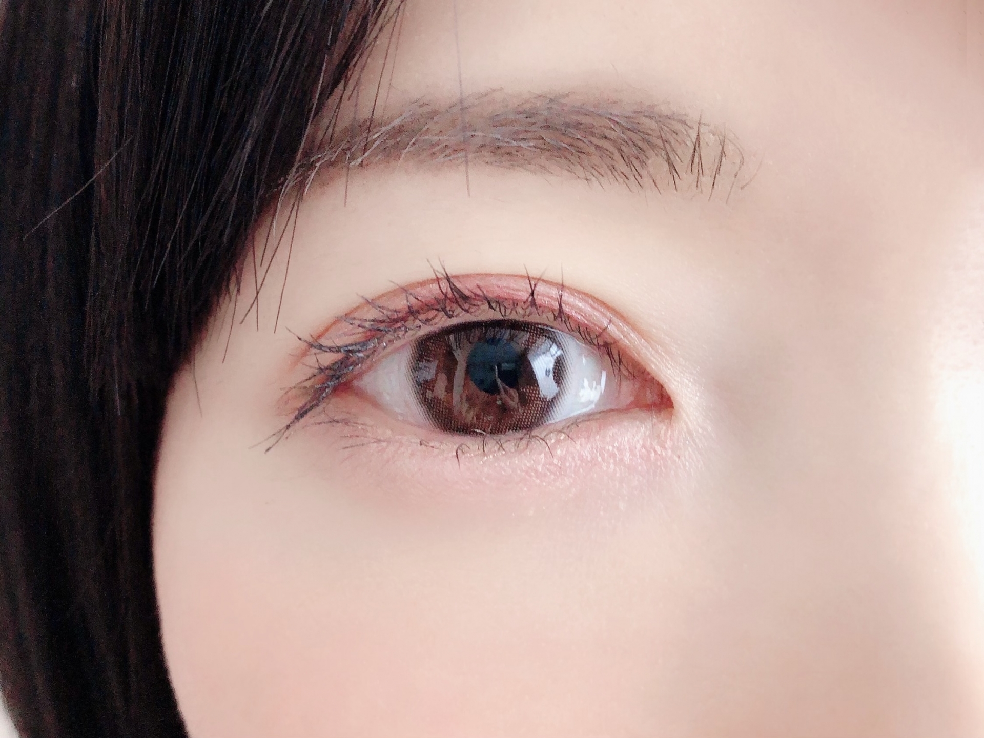 経結膜脱脂で目の下が凹んだ？取りすぎの失敗原因と他院修正の方法