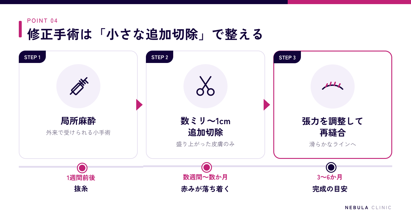 ドッグイヤー修正手術の流れ（局所麻酔で盛り上がった皮膚を数ミリ〜1cm追加切除→張力を調整して再縫合→1週間前後で抜糸・3〜6か月で完成）の図解