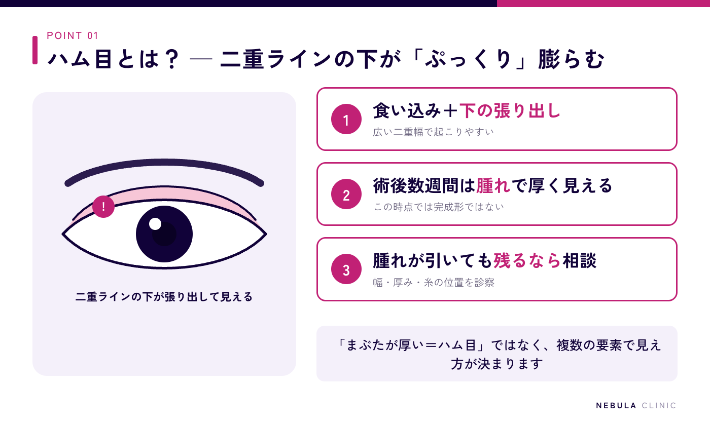 ハム目(二重ラインの下がぷっくり膨らんで見える状態)と術後の一時的な腫れとの見分け方を示した図解