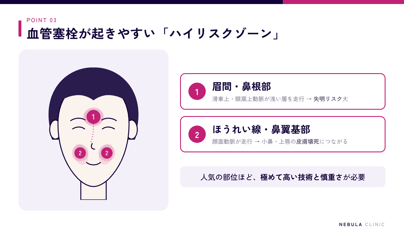 血管塞栓が起きやすい危険部位(眼動脈に繋がる滑車上動脈・眼窩上動脈が走る眉間や鼻根部、顔面動脈が走るほうれい線や鼻翼基部)を顔のイラストで示した図解