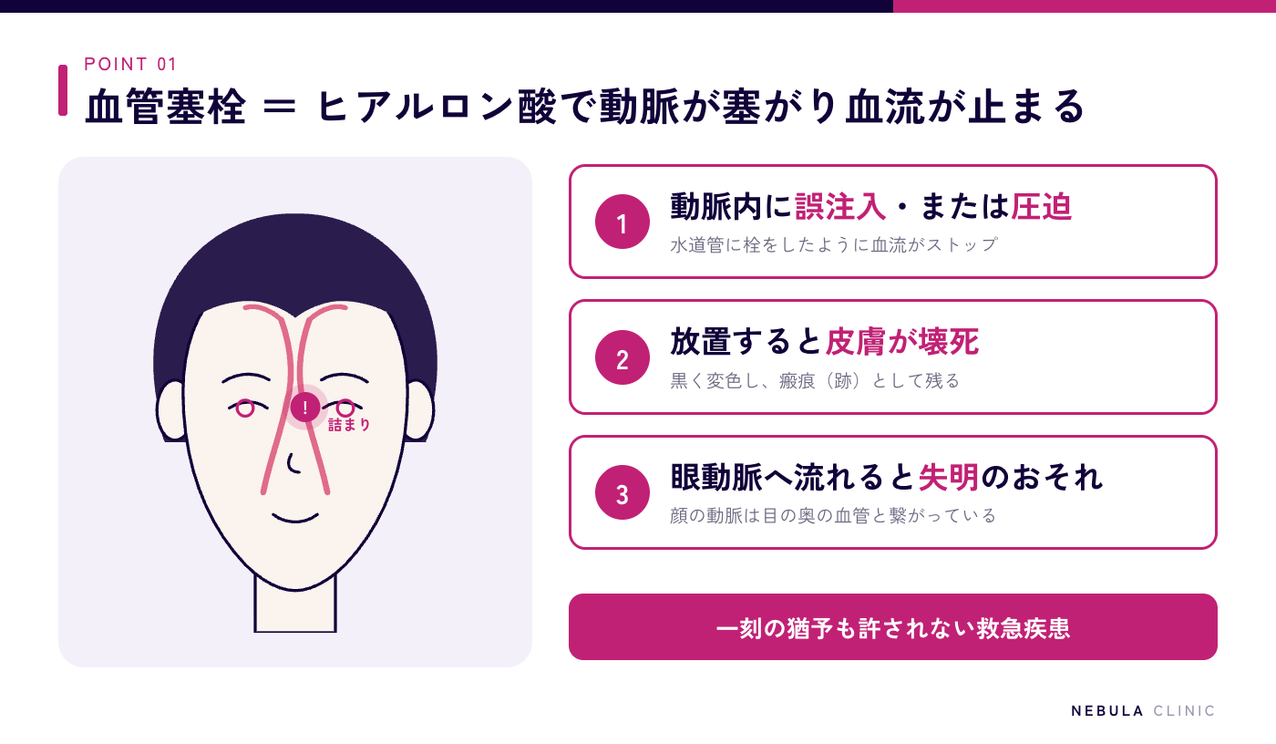 ヒアルロン酸注入の血管塞栓の仕組み(動脈内へ誤注入または圧迫で血流が止まり、放置すると皮膚壊死、眼動脈に及ぶと失明に至る)の図解