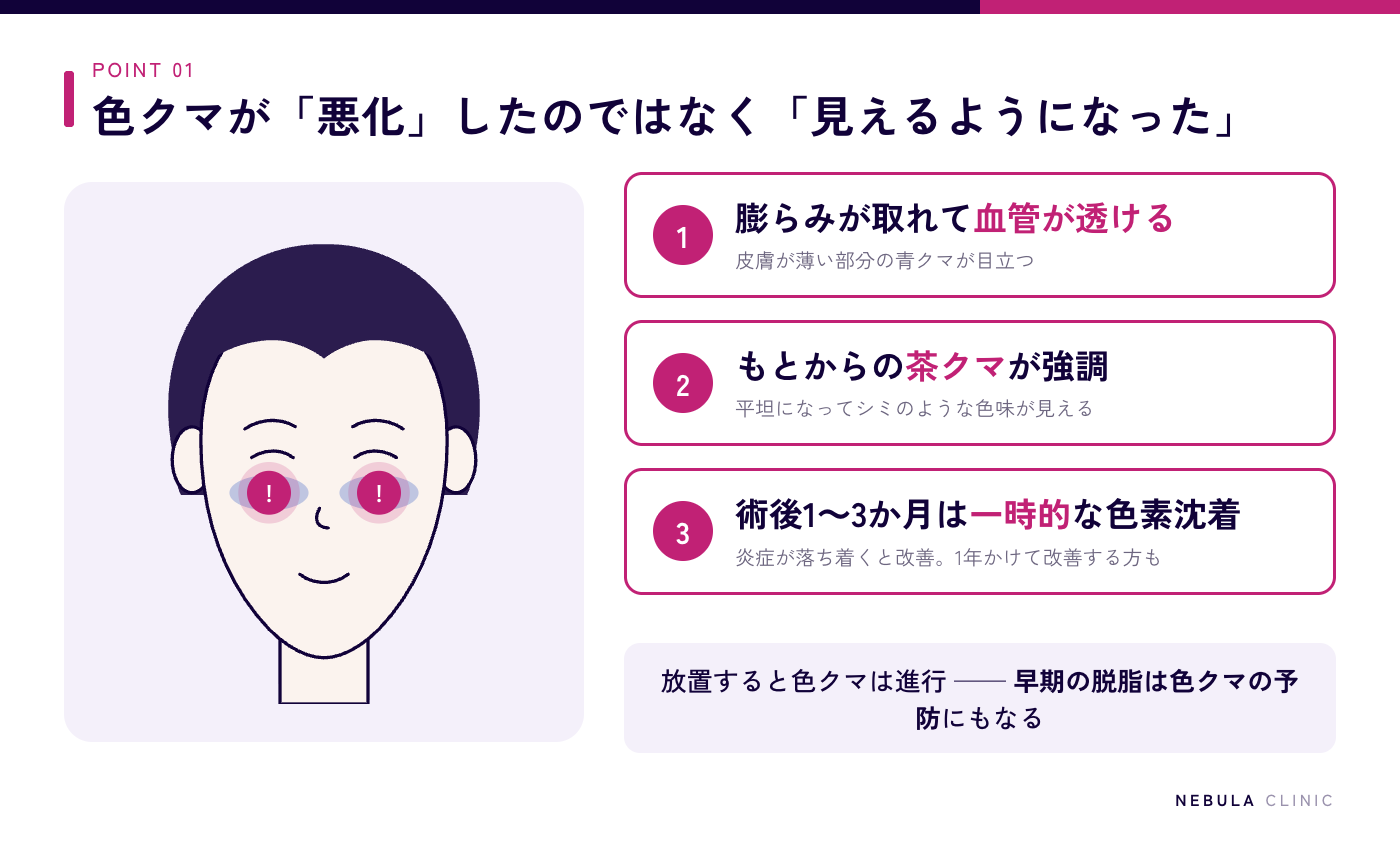 クマ取り後に色素沈着が悪化して見える3つの原因(膨らみがなくなり血管が透ける青クマ・もともとあった茶クマが強調される・術後の炎症による一時的な色素沈着)の図解