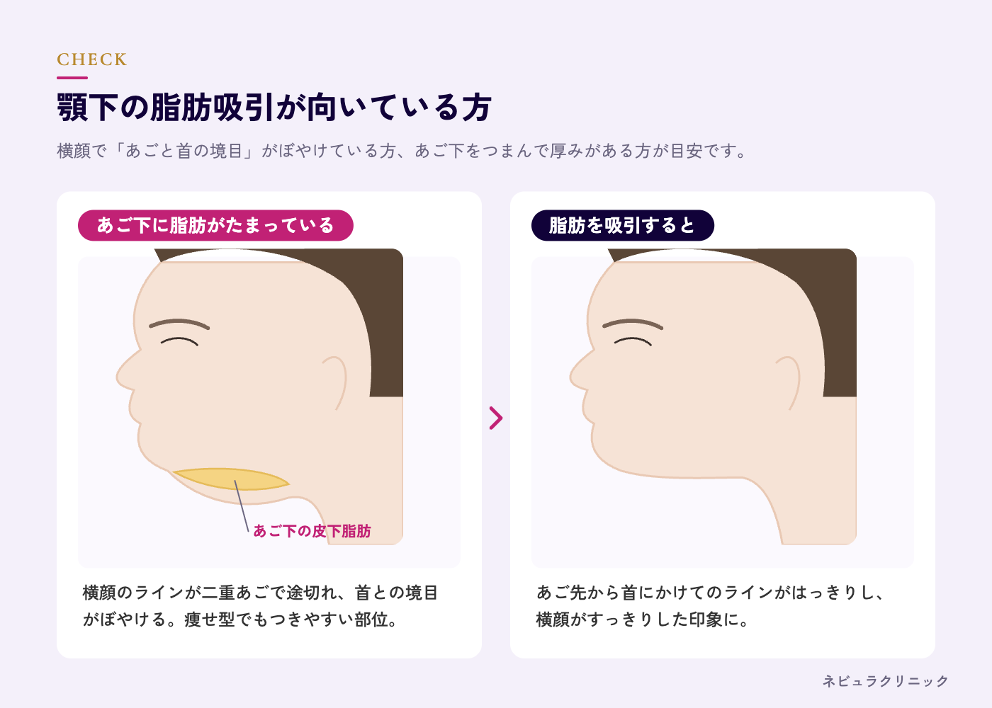 顎下の脂肪吸引が向いている方(二重あご・横顔のもたつき)の図解