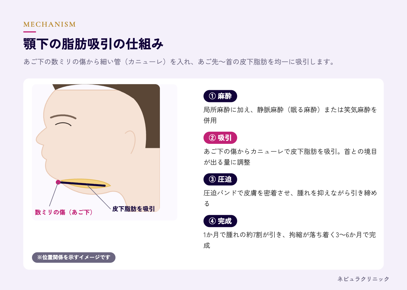 顎下の脂肪吸引の仕組み(あご下の小さな傷からカニューレで吸引・横顔の変化)の図解