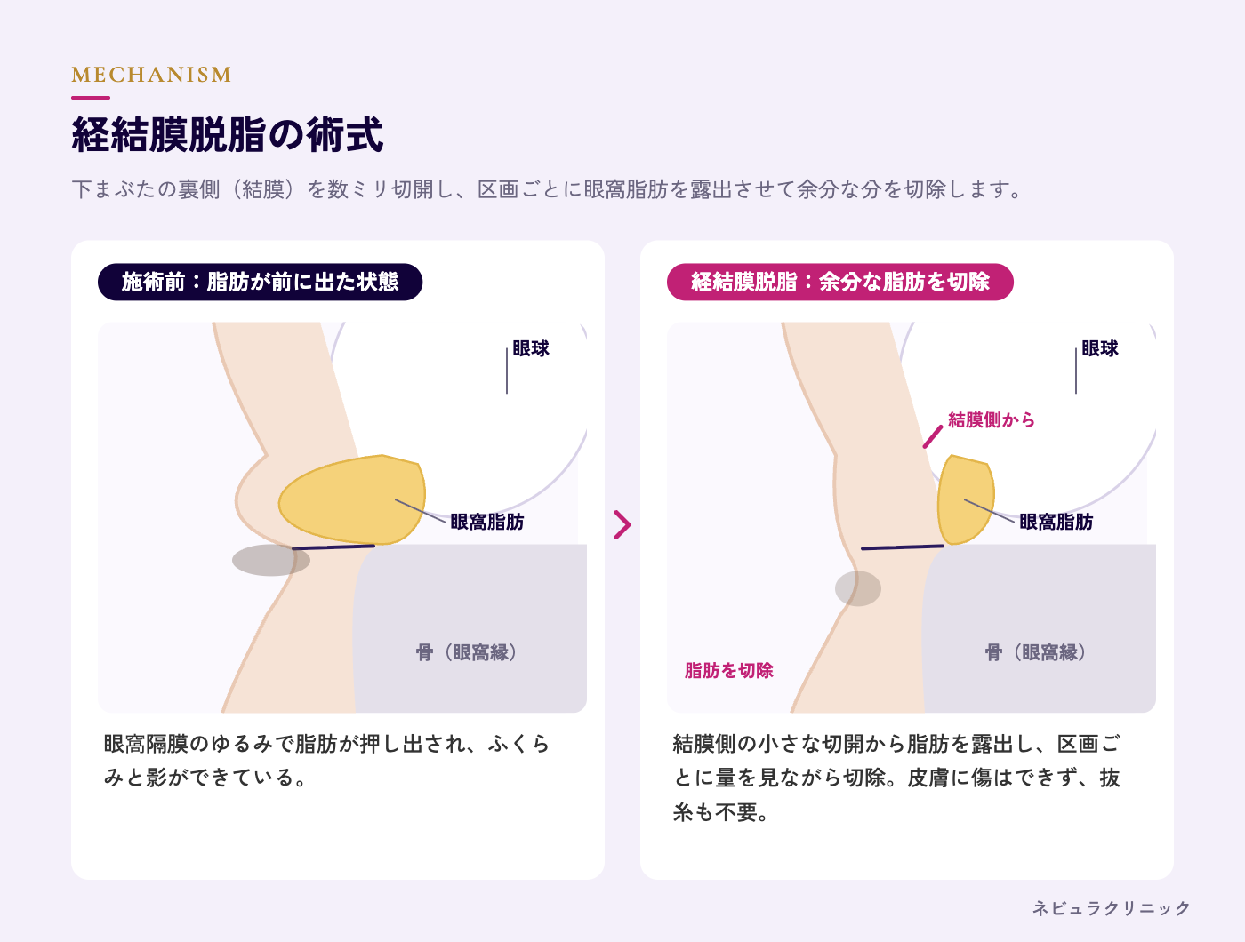 経結膜脱脂の術式（結膜切開・脂肪の露出・切除）の図解