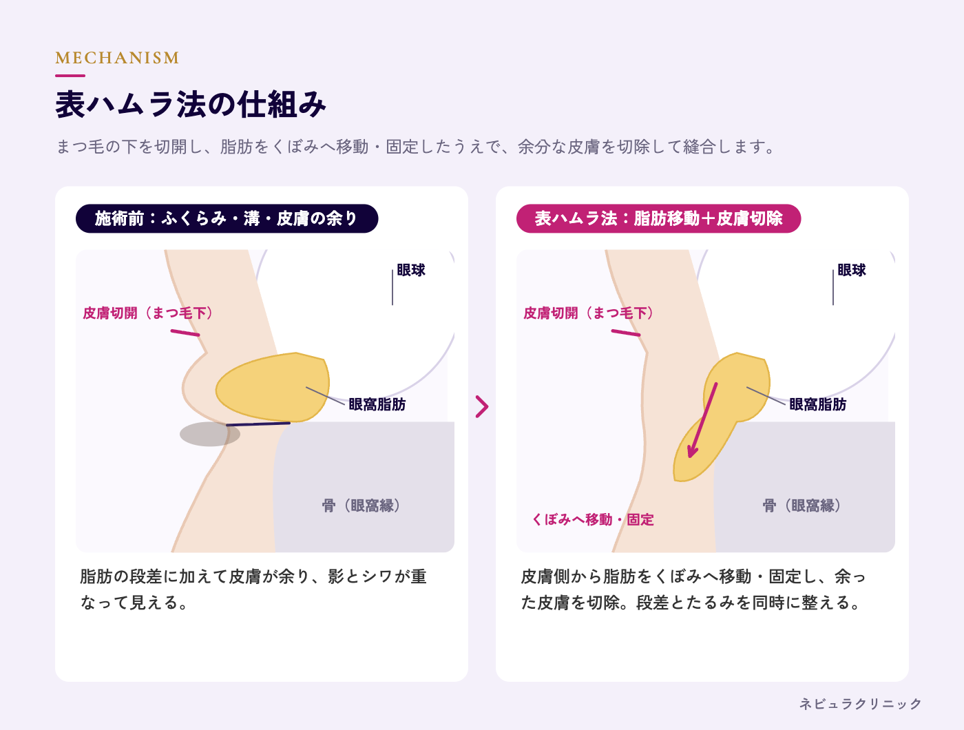 表ハムラ法の仕組み（まつ毛下の切開・脂肪移動・皮膚切除）の図解
