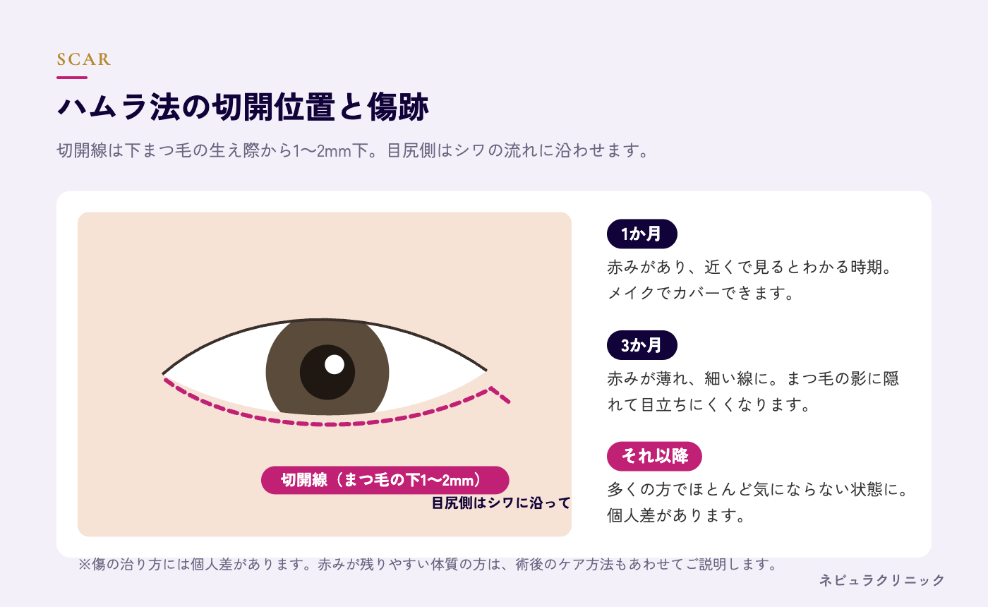 ハムラ法の切開位置と傷跡の目立ちにくさの図解