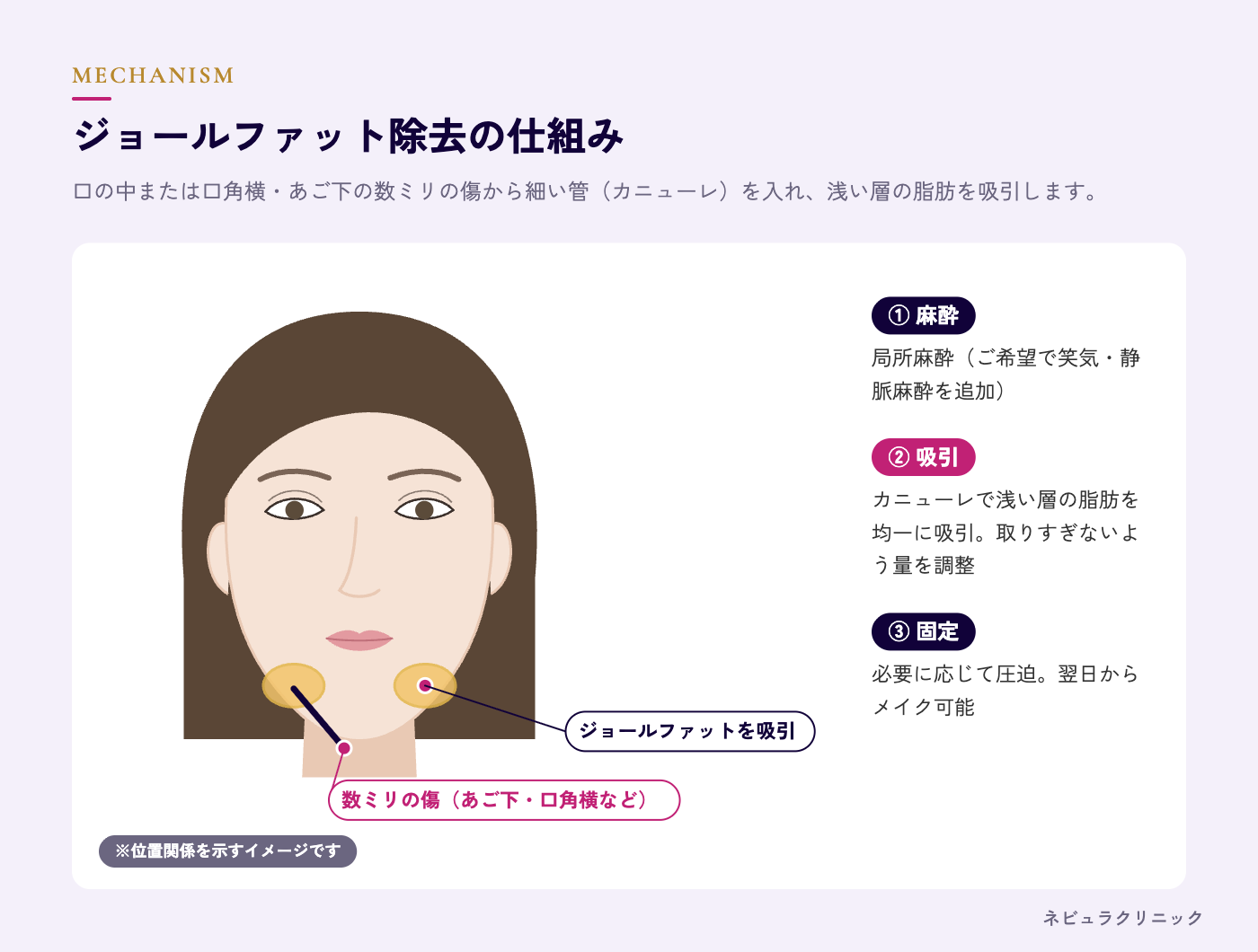 ジョールファット除去の仕組み（口腔内または口角横の小さな傷からの吸引）の図解