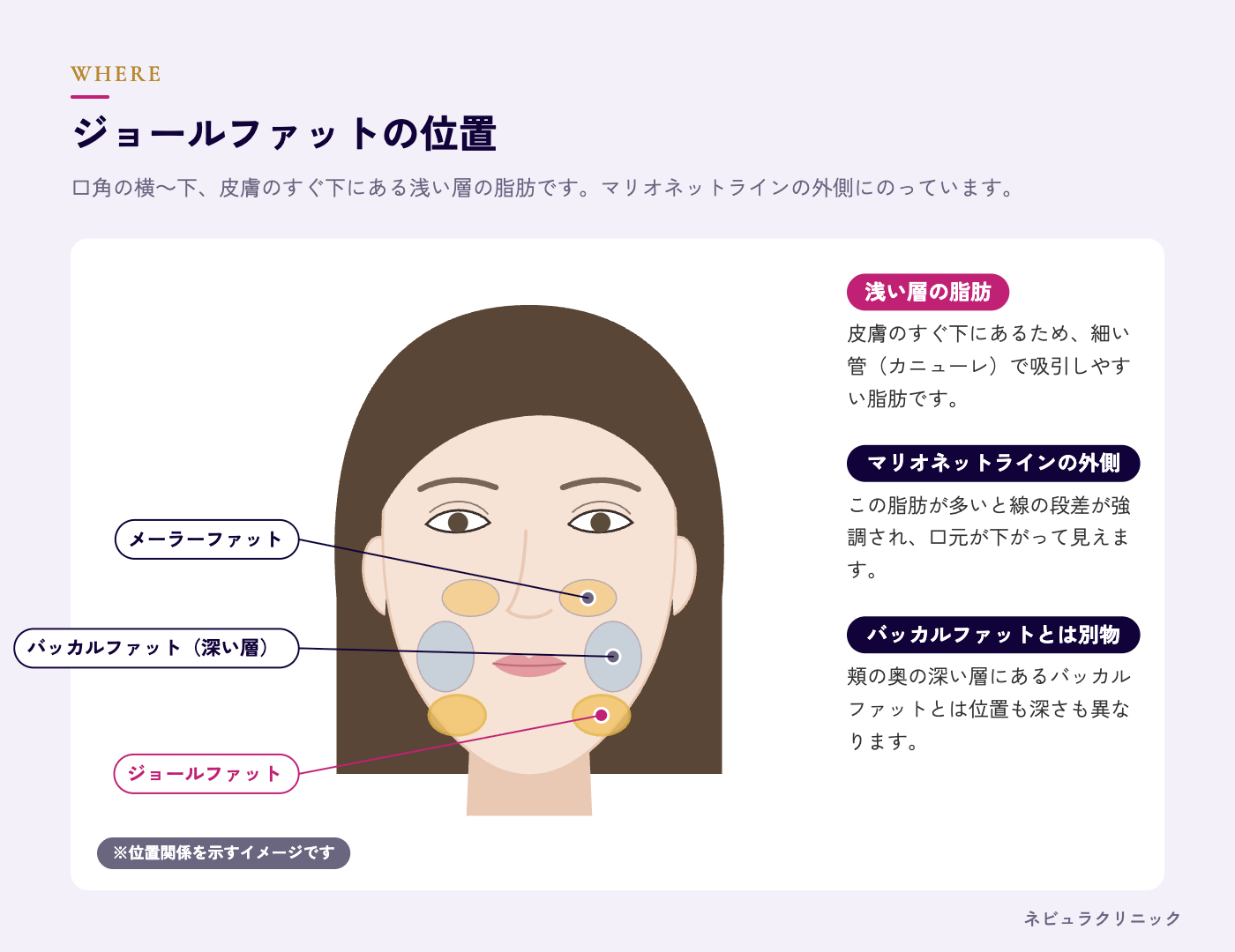 ジョールファットの位置（口角の横〜下、マリオネットラインの外側）の図解