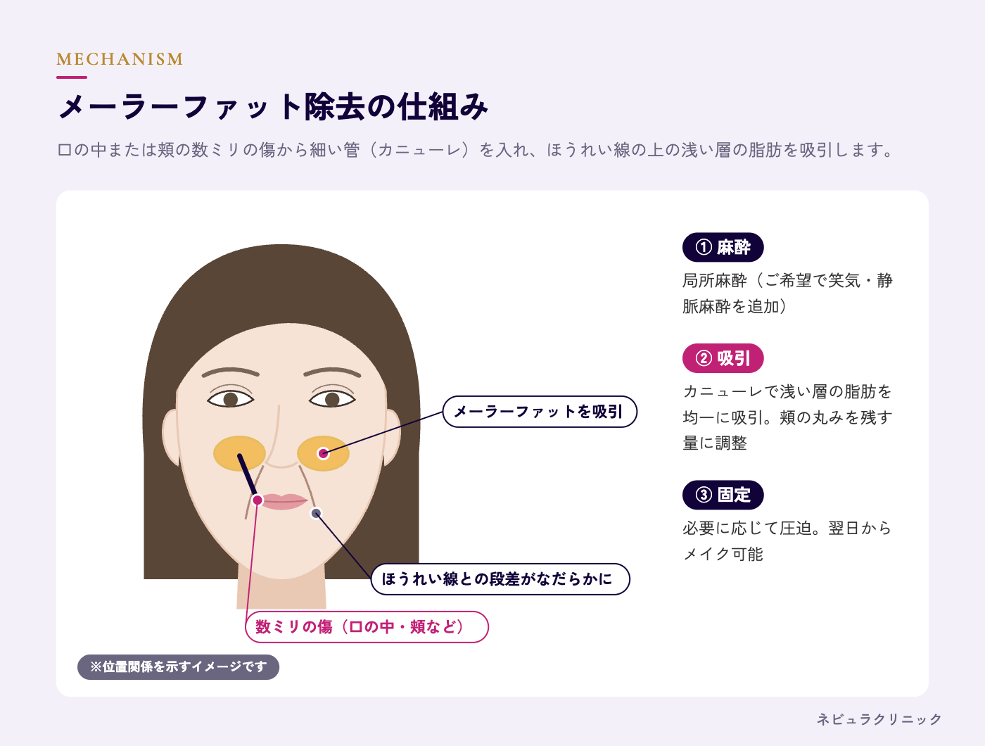 メーラーファット除去の仕組み(口腔内または頬の小さな傷からの吸引)の図解