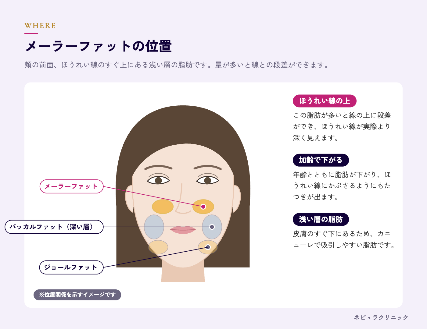 メーラーファットの位置(頬の前面・ほうれい線の上)の図解