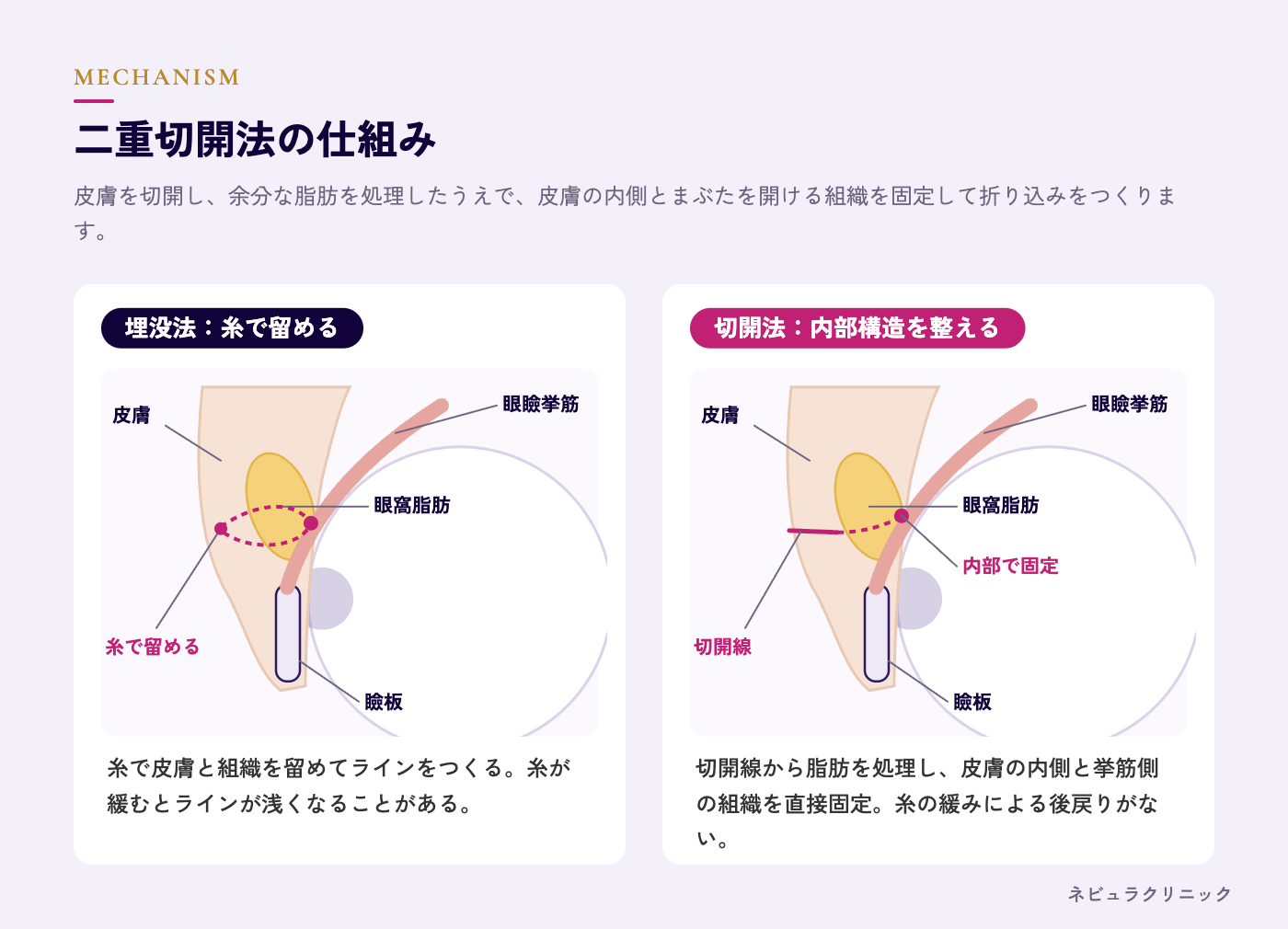 二重切開法の仕組み（切開・脂肪処理・内部固定）の図解