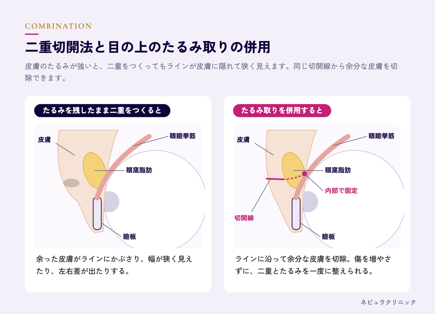 切開法と目の上のたるみ取り（上眼瞼除皺術）の併用の図解