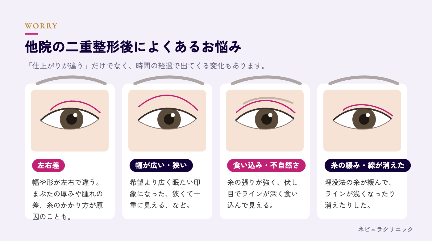 他院の二重整形後によくあるお悩み（左右差・幅・食い込み・糸の緩み）の図解