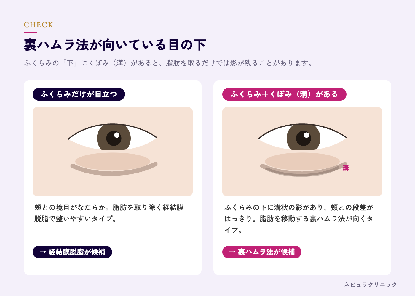 裏ハムラ法が向いている方(ふくらみとくぼみが同時にある目の下)の図解