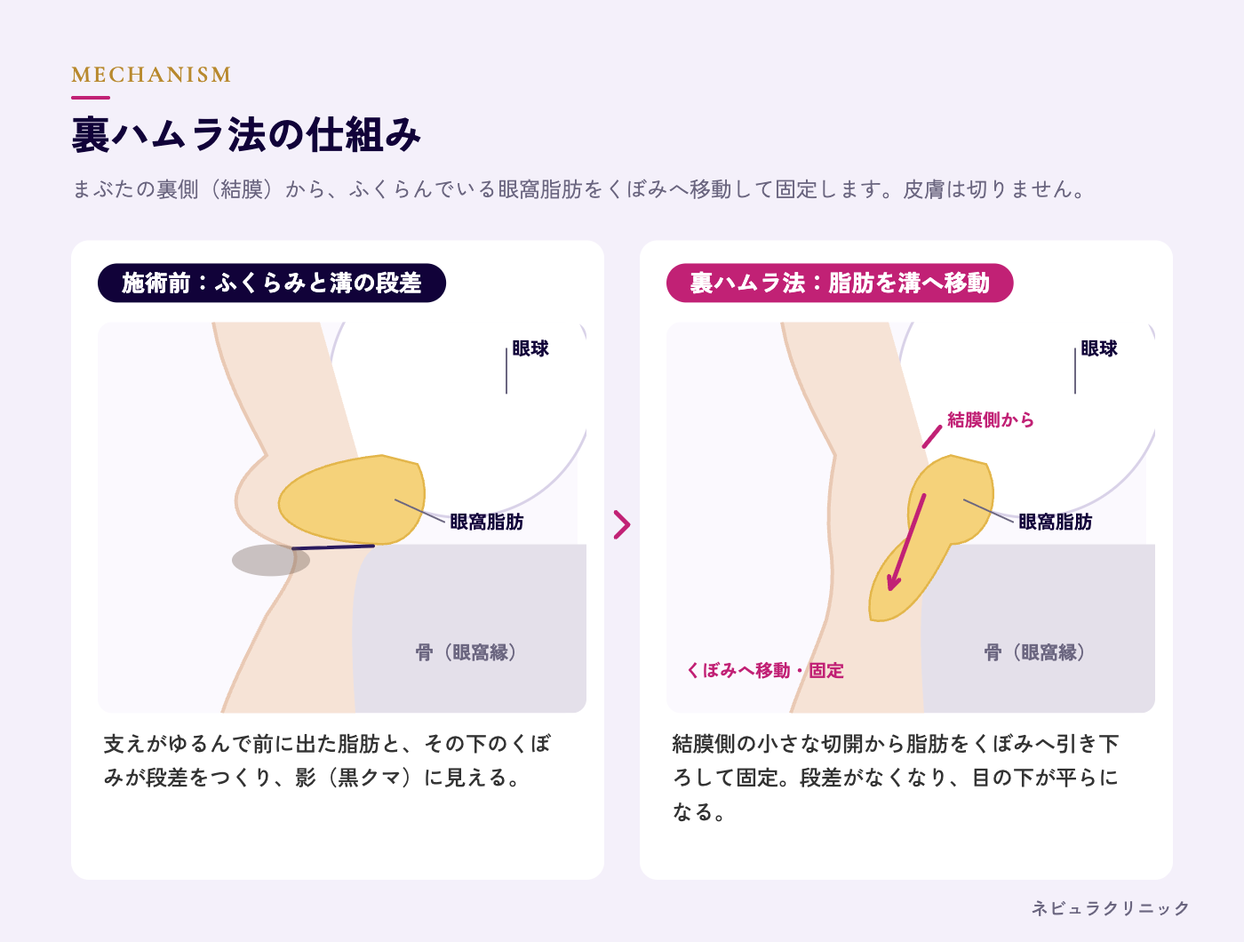 裏ハムラ法の仕組み(まぶたの裏側から脂肪をくぼみへ移動)の図解