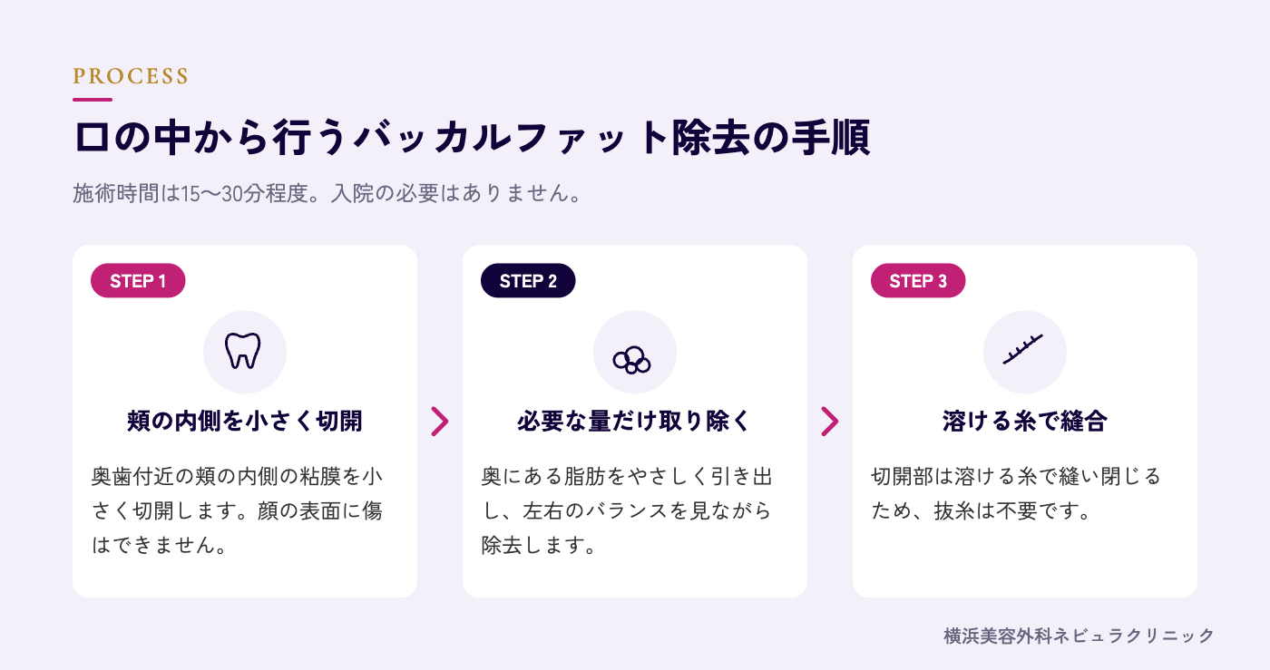 口の中から行うバッカルファット除去の手順の図解
