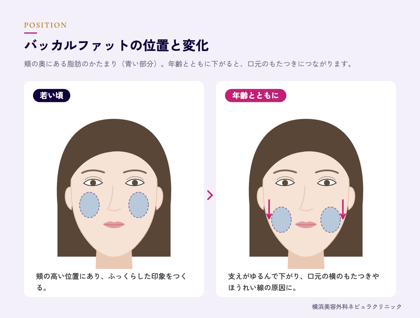 バッカルファットの位置（頬の奥の脂肪）と加齢による下垂の図解
