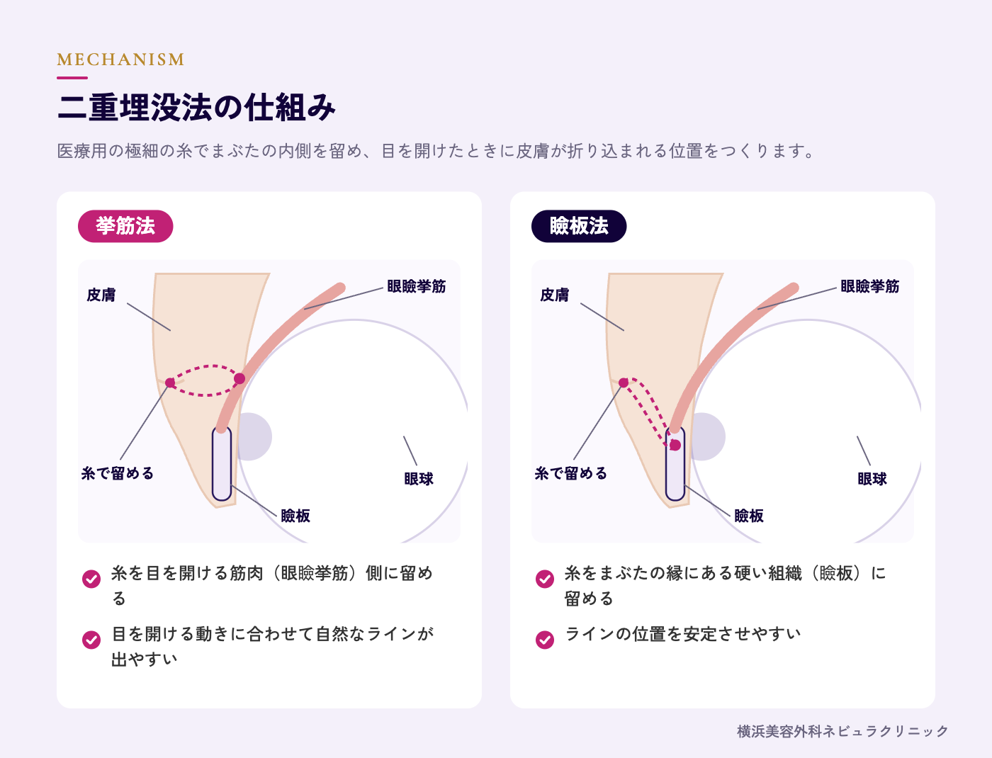 二重埋没法の仕組み(挙筋法と瞼板法)の図解
