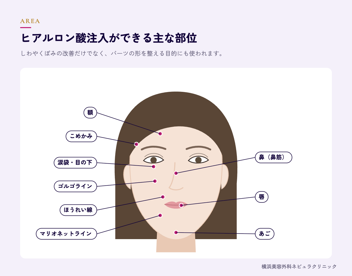 ヒアルロン酸注入ができる顔の部位マップの図解