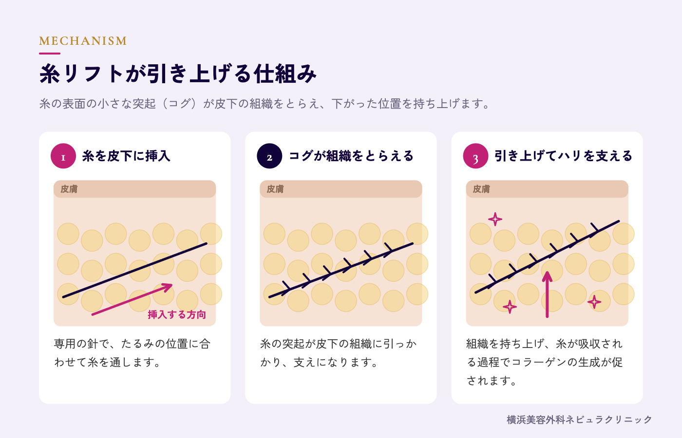 糸リフトの仕組み(コグが組織を引き上げる)の図解
