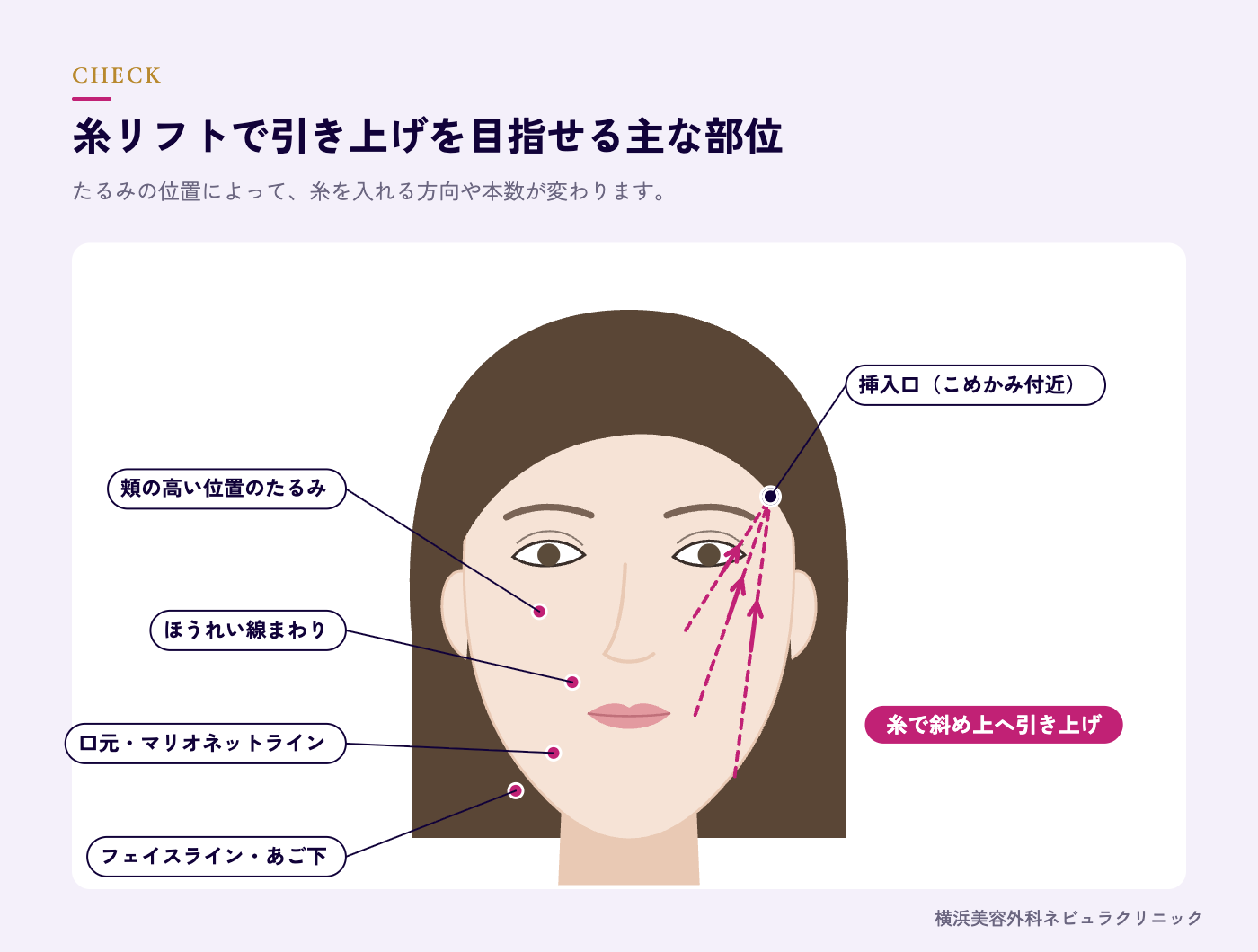 糸リフトで引き上げる頬・フェイスライン・口元のたるみの位置の図解