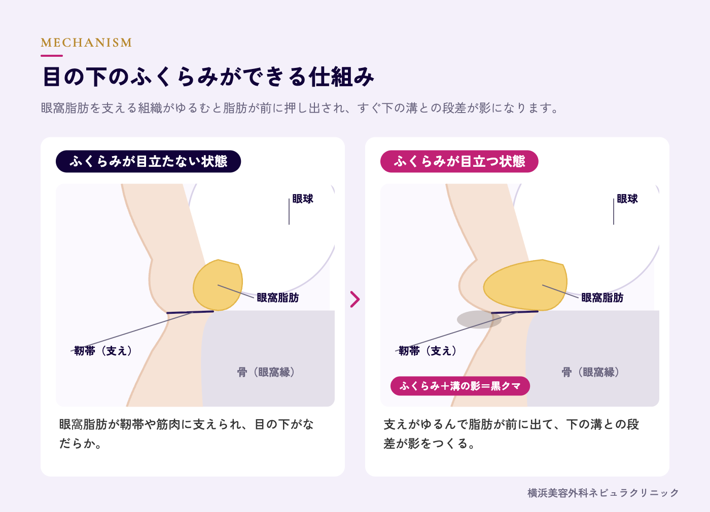 目の下のふくらみができる仕組み(眼窩脂肪と靭帯)の図解
