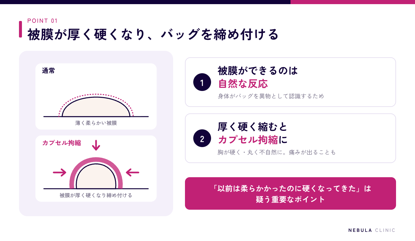 カプセル拘縮の仕組み（通常はバッグの周囲に薄く柔らかい被膜ができるが、カプセル拘縮では被膜が厚く硬くなってバッグを締め付け、胸が硬く丸く不自然になる）を抽象的な図形で示した図解