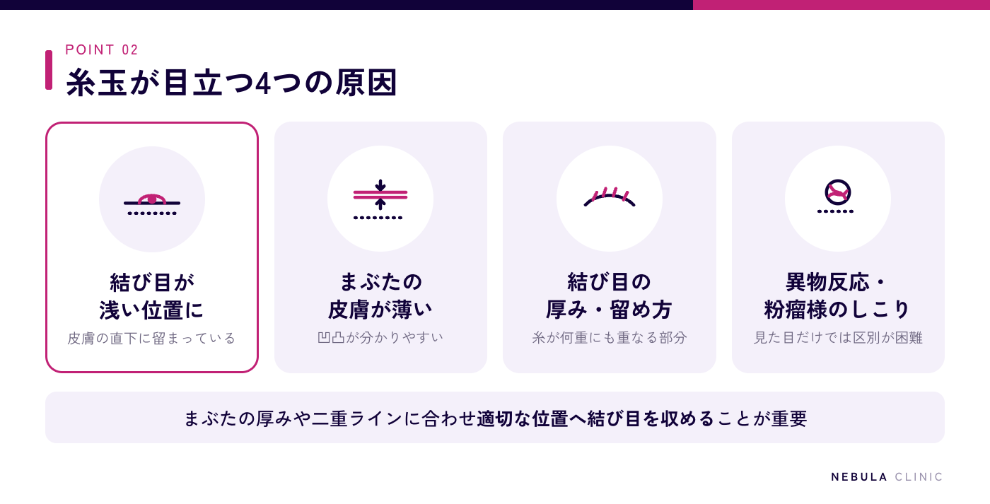 まぶたに糸玉が目立つ4つの主な原因の図解（結び目の埋め込みが浅い、まぶたの皮膚が薄い、結び目の厚みが出る留め方、糸への異物反応や粉瘤様のしこり）