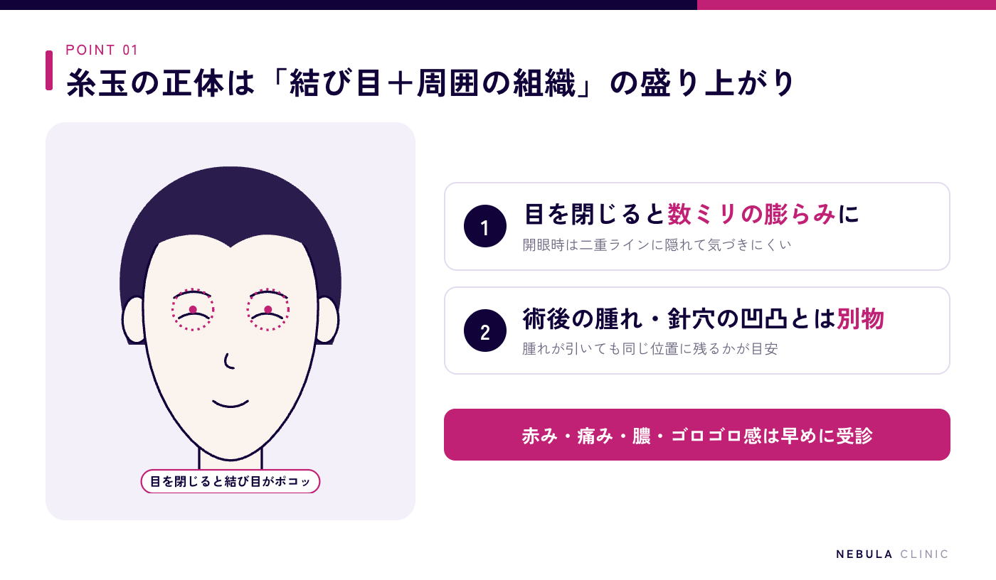 二重埋没法の糸玉がポコッと浮き出る症状の図解（目を閉じた時にまぶたの結び目と周囲の組織が数ミリの小さな盛り上がりとして見える、術後の一時的な腫れや針穴の凹凸とは別物、赤み・痛み・膿・ゴロゴロ感は早めに受診）