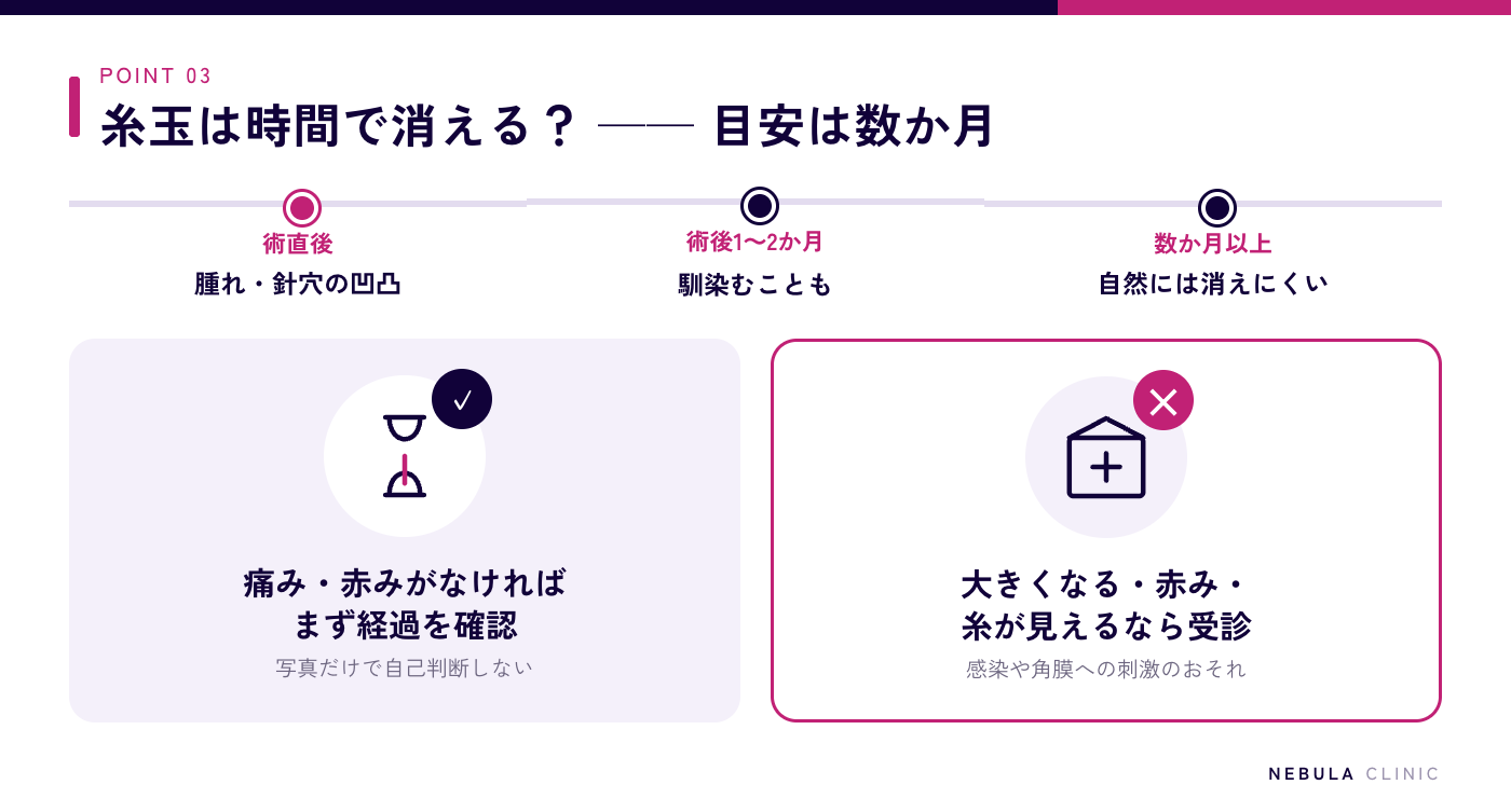 糸玉が時間経過で消えるかの目安の図解（術直後は腫れや針穴の凹凸、術後1〜2か月は組織が落ち着き馴染むこともある、数か月以上残る場合は自然には消えにくく、大きくなる・赤み・痛み・糸が見える場合は早めに診察）